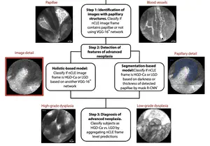 High performance in risk stratification of intraductal papillary mucinous neoplasms by confocal laser endomicroscopy image analysis with convolutional neural networks (with video)