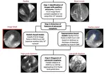 High performance in risk stratification of intraductal papillary mucinous neoplasms by confocal laser endomicroscopy image analysis with convolutional neural networks (with video)